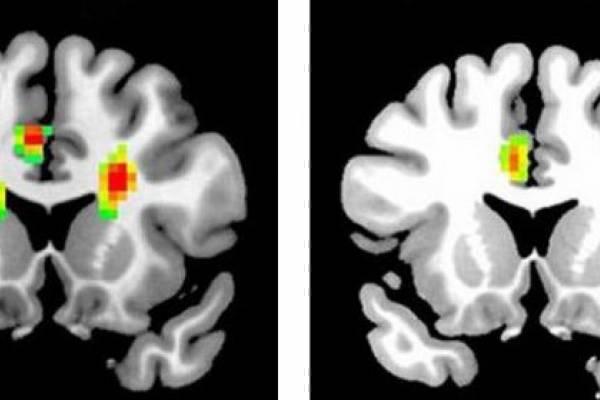 Ученые увидели любовь на сканах мозга человека