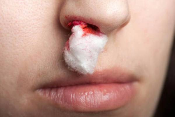 Как определить причины носовых кровотечений