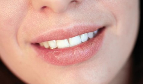 Какие существуют средства для потрескавшихся губ