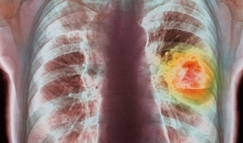 Оказалось, что кислород может вызвать рак легких