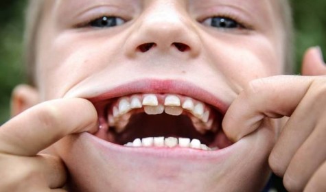 Мальчик с двумя рядами зубов шокировал стоматологов