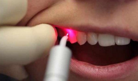 Повреждённые зубы можно восстановить лазером